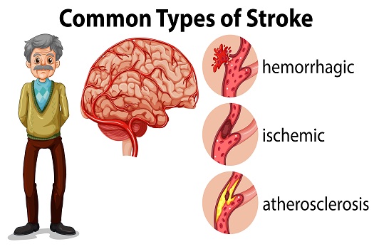 What Are the Types of Strokes in Tucson, AZ